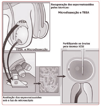 esperma