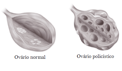 ovaros poliscisticos